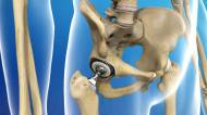 протезирование тазобедренного сустава
