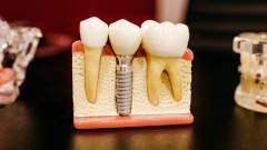 імплантація зубів